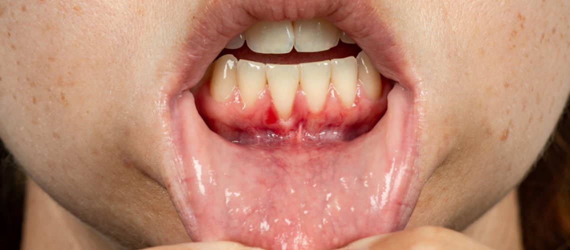 Gum Recession A Warning Sign Of Gum Disease Rochester NY Webster 